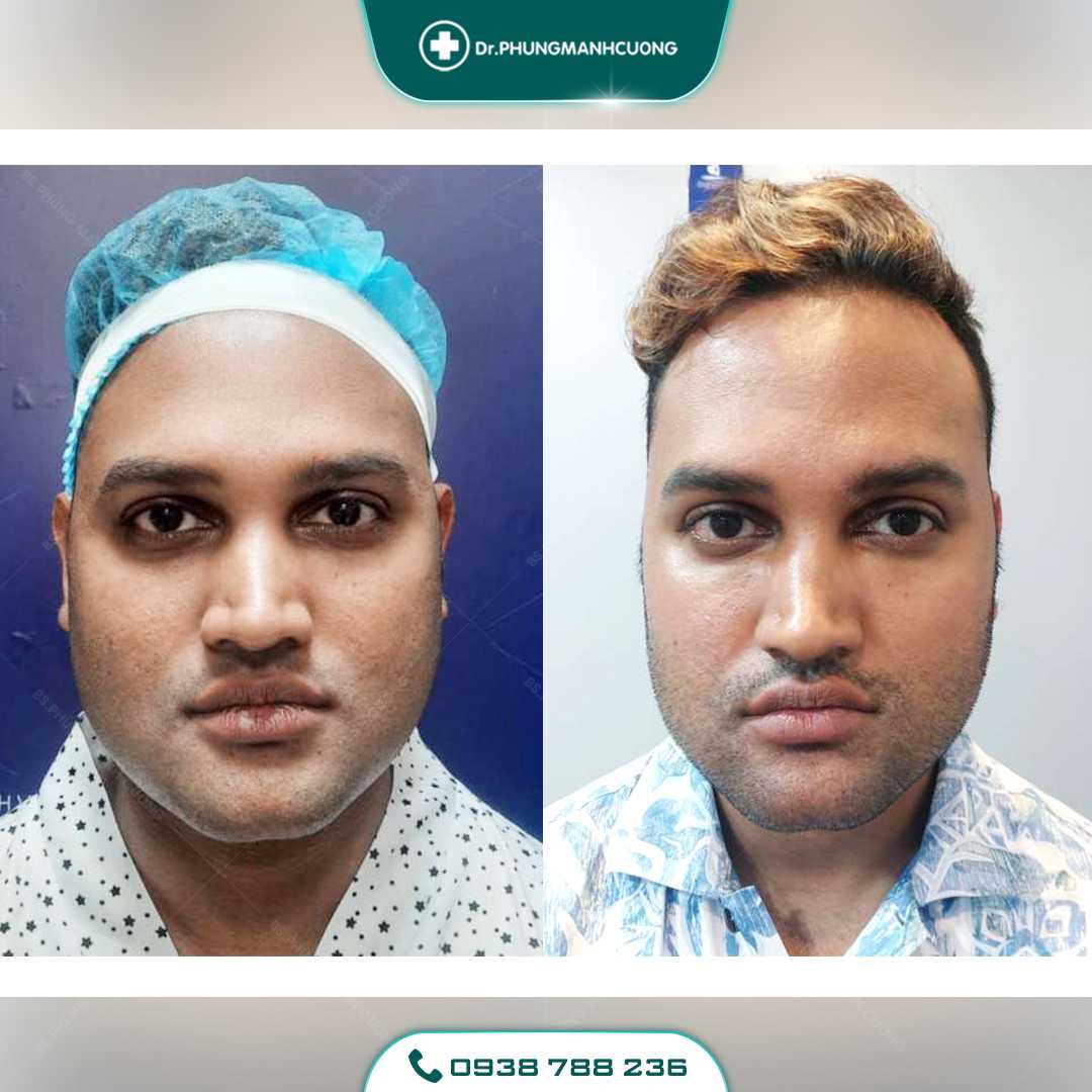 Hút Mỡ Mặt, Hút Mỡ Má Cho Khuôn Mặt Thon Gọn V Line 21 1 PMC 1