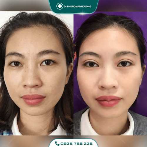 Tạo Khóe Môi Cười Làm Khuôn Mặt Luôn Tươi Tắn Rạng Ngời 24 10 PMC