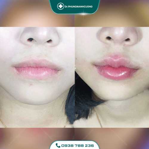 Tạo Khóe Môi Cười Làm Khuôn Mặt Luôn Tươi Tắn Rạng Ngời 25 12 PMC