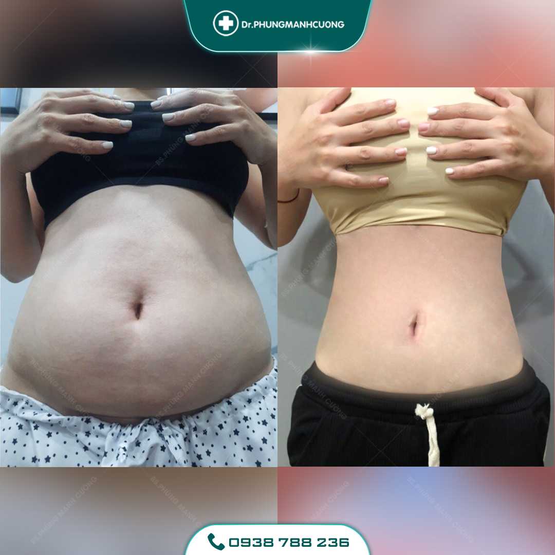 Lipo Minfat: Hút Mỡ Bằng Công Nghệ Mới, An Toàn Hiện Nay 27 16 PMC