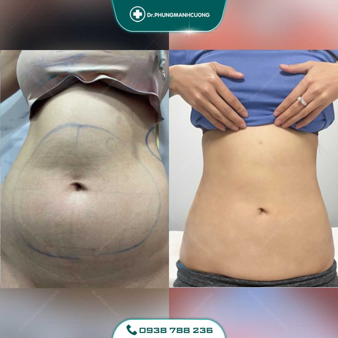 Lipo Minfat: Hút Mỡ Bằng Công Nghệ Mới, An Toàn Hiện Nay 26 17 PMC