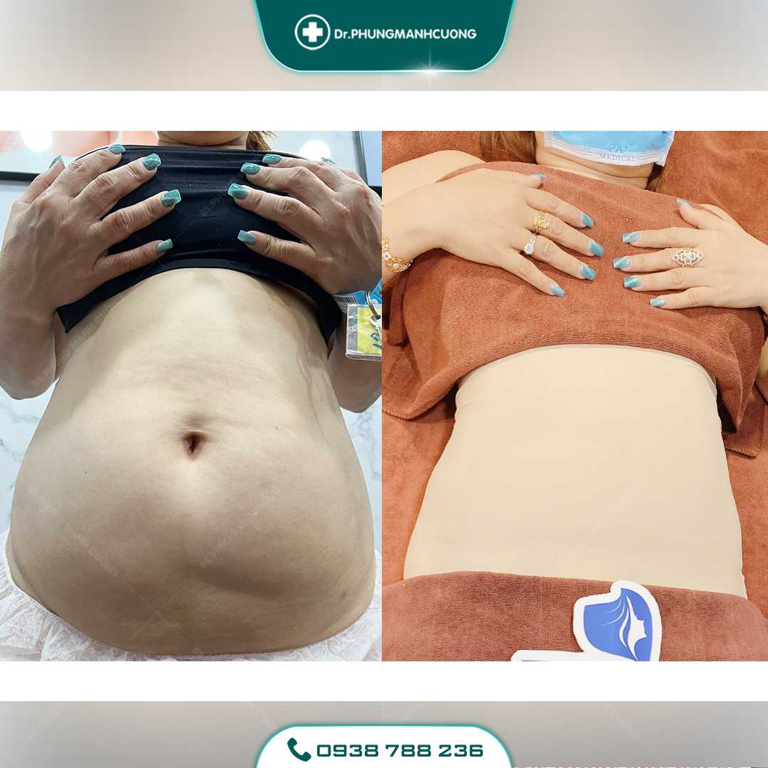 Lipo Minfat: Hút Mỡ Bằng Công Nghệ Mới, An Toàn Hiện Nay 25 18 PMC