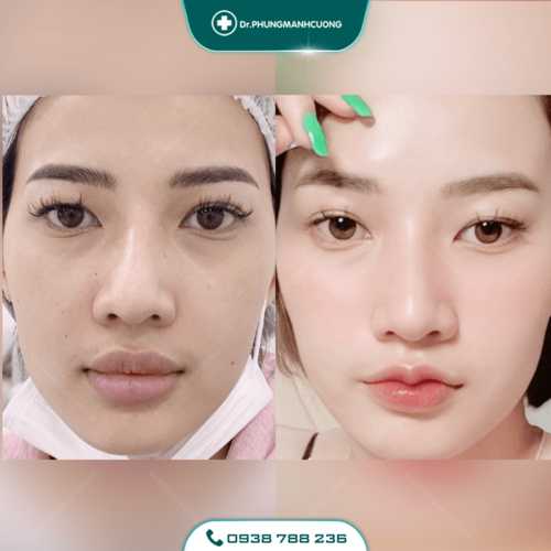 Tạo Khóe Môi Cười Làm Khuôn Mặt Luôn Tươi Tắn Rạng Ngời 30 19 PMC