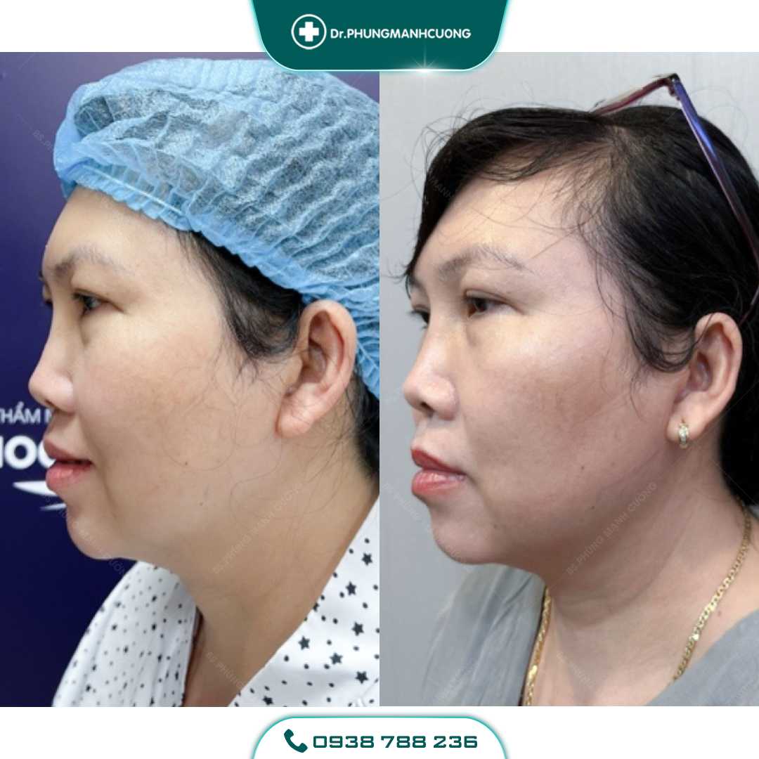 Hút Mỡ Mặt, Hút Mỡ Má Cho Khuôn Mặt Thon Gọn V Line 17 1 PMC 1