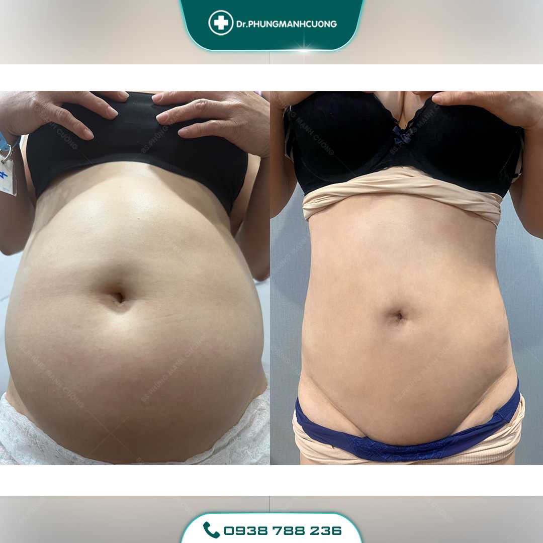 Giảm Béo Bằng Công Nghệ Mới - Lipo Thin Max 34 20 PMC