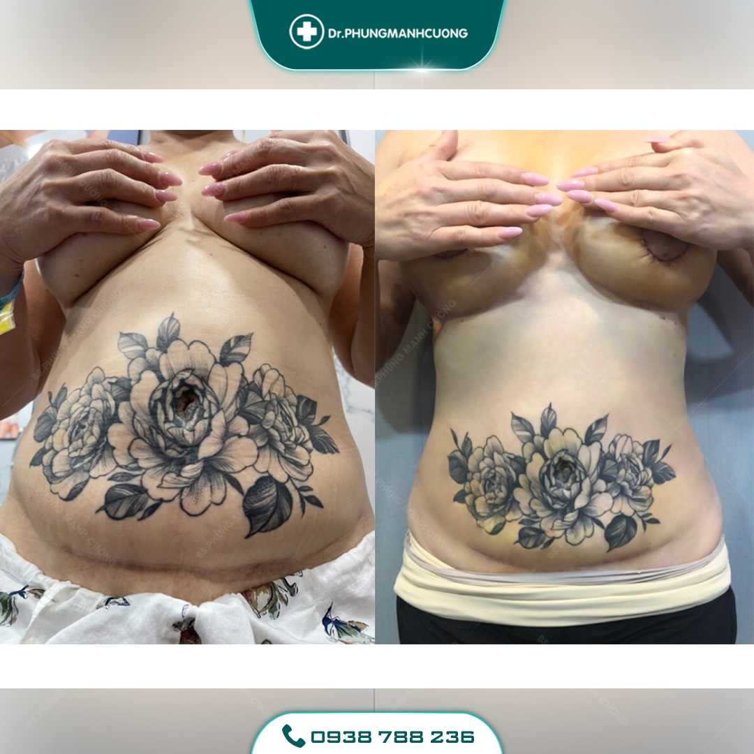 Lipo Minfat: Hút Mỡ Bằng Công Nghệ Mới, An Toàn Hiện Nay 23 21 PMC