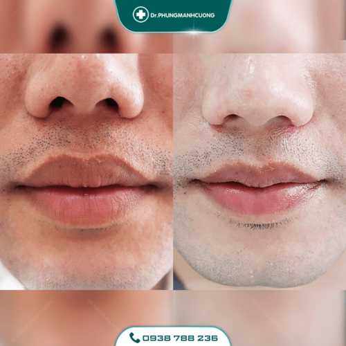 Tạo Khóe Môi Cười Làm Khuôn Mặt Luôn Tươi Tắn Rạng Ngời 31 21 PMC