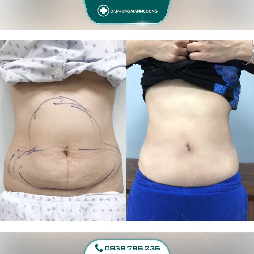 Giảm Béo Bằng Công Nghệ Mới - Lipo Thin Max 36 22 PMC