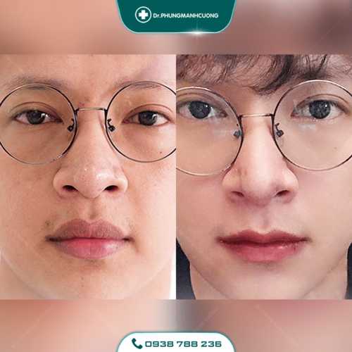 Tạo Khóe Môi Cười Làm Khuôn Mặt Luôn Tươi Tắn Rạng Ngời 26 22 PMC