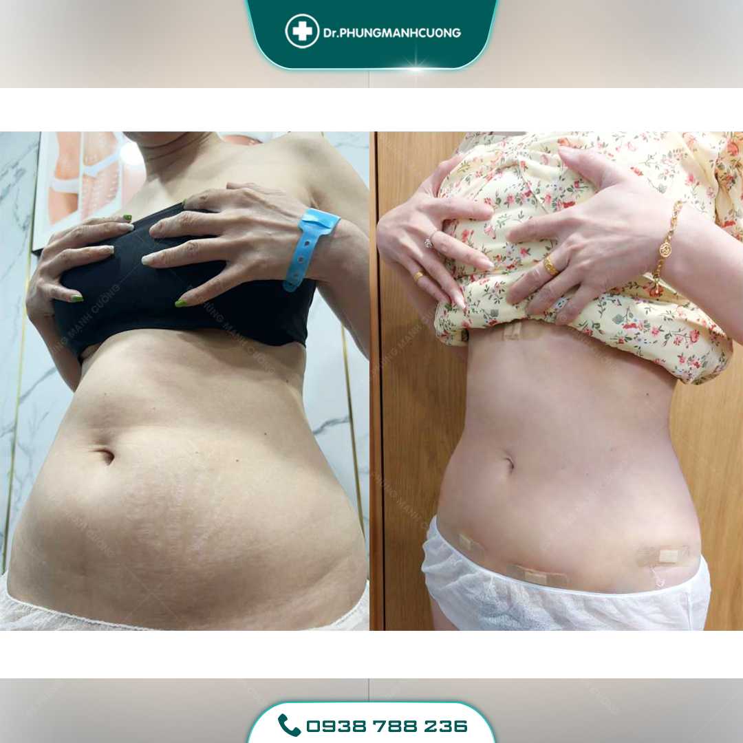 Giảm Béo Bằng Công Nghệ Mới - Lipo Thin Max 37 23 PMC