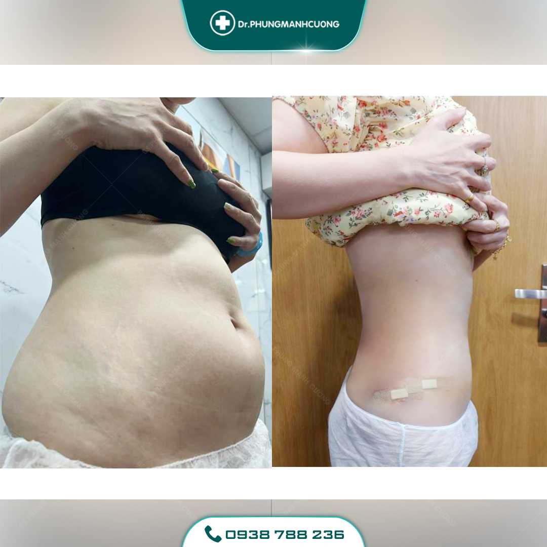 Giảm Béo Bằng Công Nghệ Mới - Lipo Thin Max 38 24 PMC