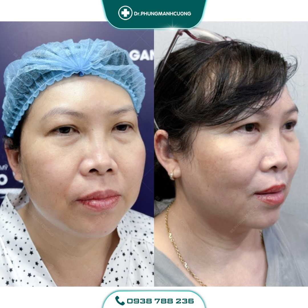 Hút Mỡ Mặt, Hút Mỡ Má Cho Khuôn Mặt Thon Gọn V Line 18 2 PMC 1