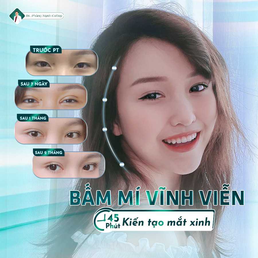 Bấm mí vĩnh viễn tạo đôi mắt to tròn, không xâm lấn quá nhiều