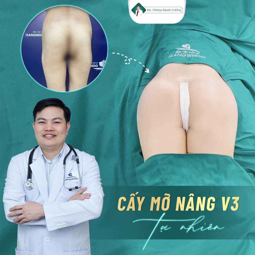Nâng Mông Bằng Mỡ Tự Thân Cho Vòng 3 Căng Đầy, Mềm Mại 15 Phương pháp này có độ tương thích cao và an toàn