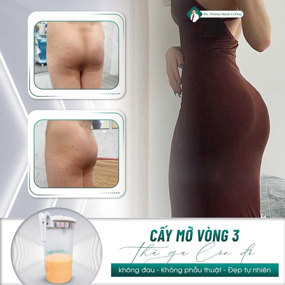 Nâng Mông Bằng Mỡ Tự Thân Cho Vòng 3 Căng Đầy, Mềm Mại 12 Nâng mông bằng mỡ tự thân giúp sở hữu vòng 2 thon gọn và vòng 3 quyến rũ