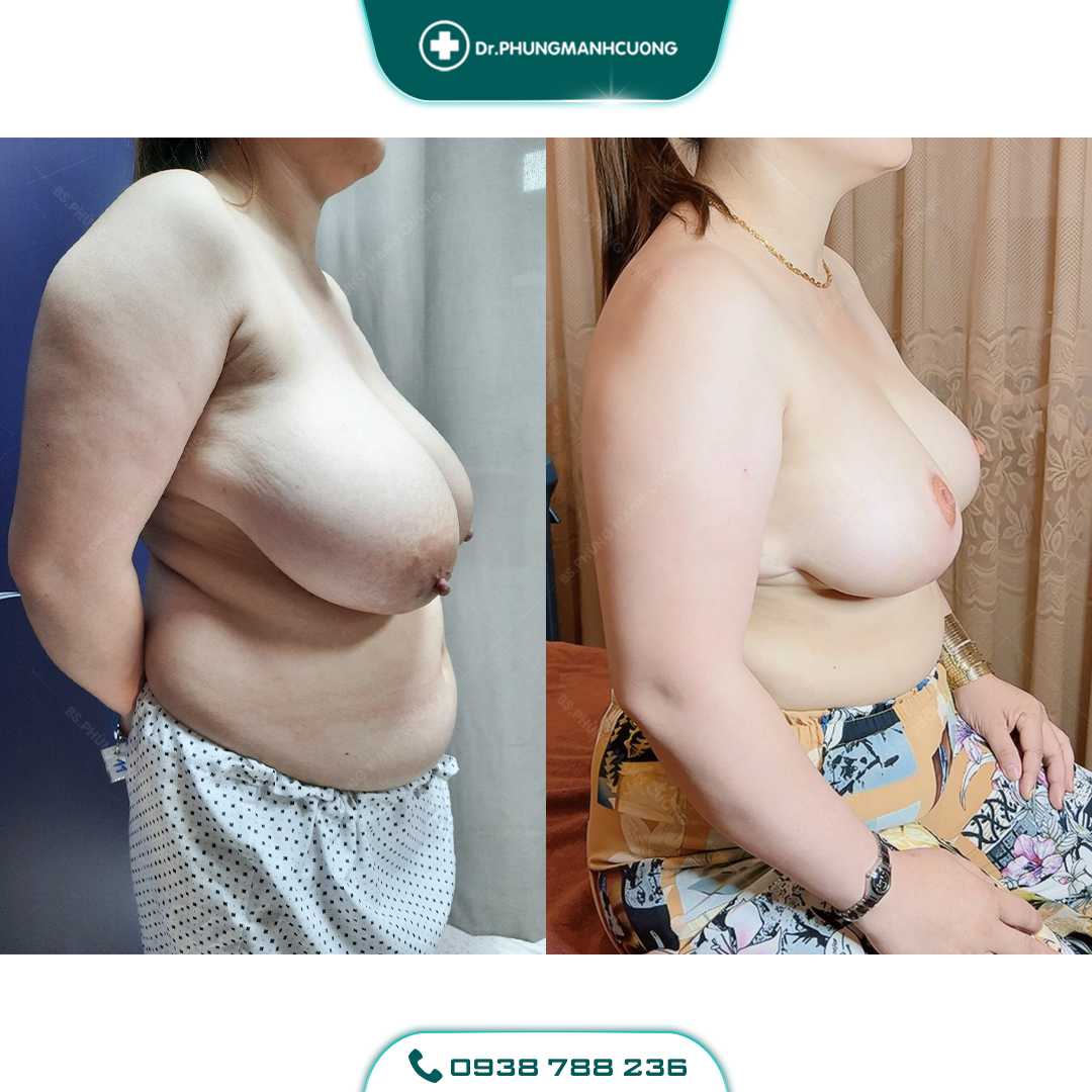 Thu Nhỏ Vú Phì Đại Giải Pháp Khắc Phục Bầu Ngực Sập Xệ 16 3 PMC