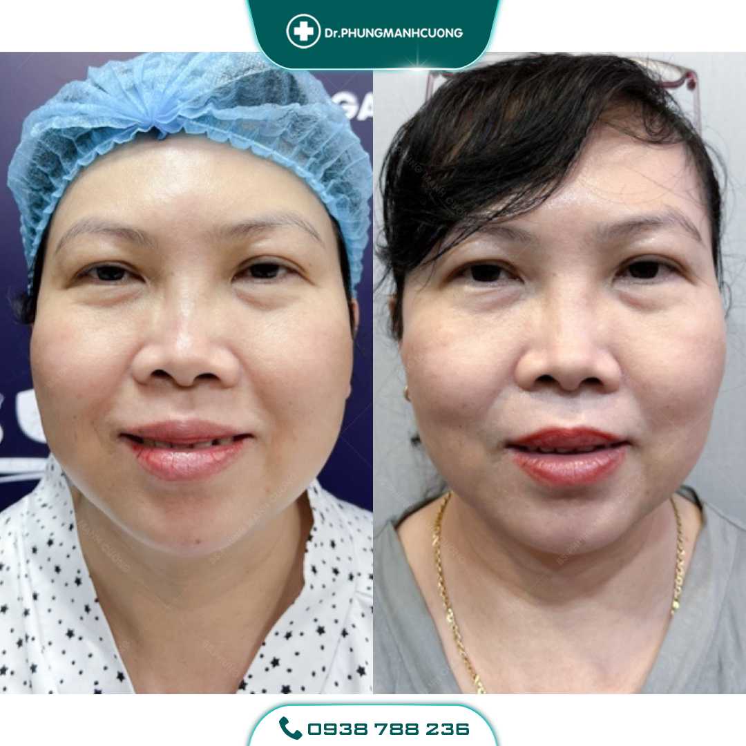 Hút Mỡ Mặt, Hút Mỡ Má Cho Khuôn Mặt Thon Gọn V Line 19 3 PMC