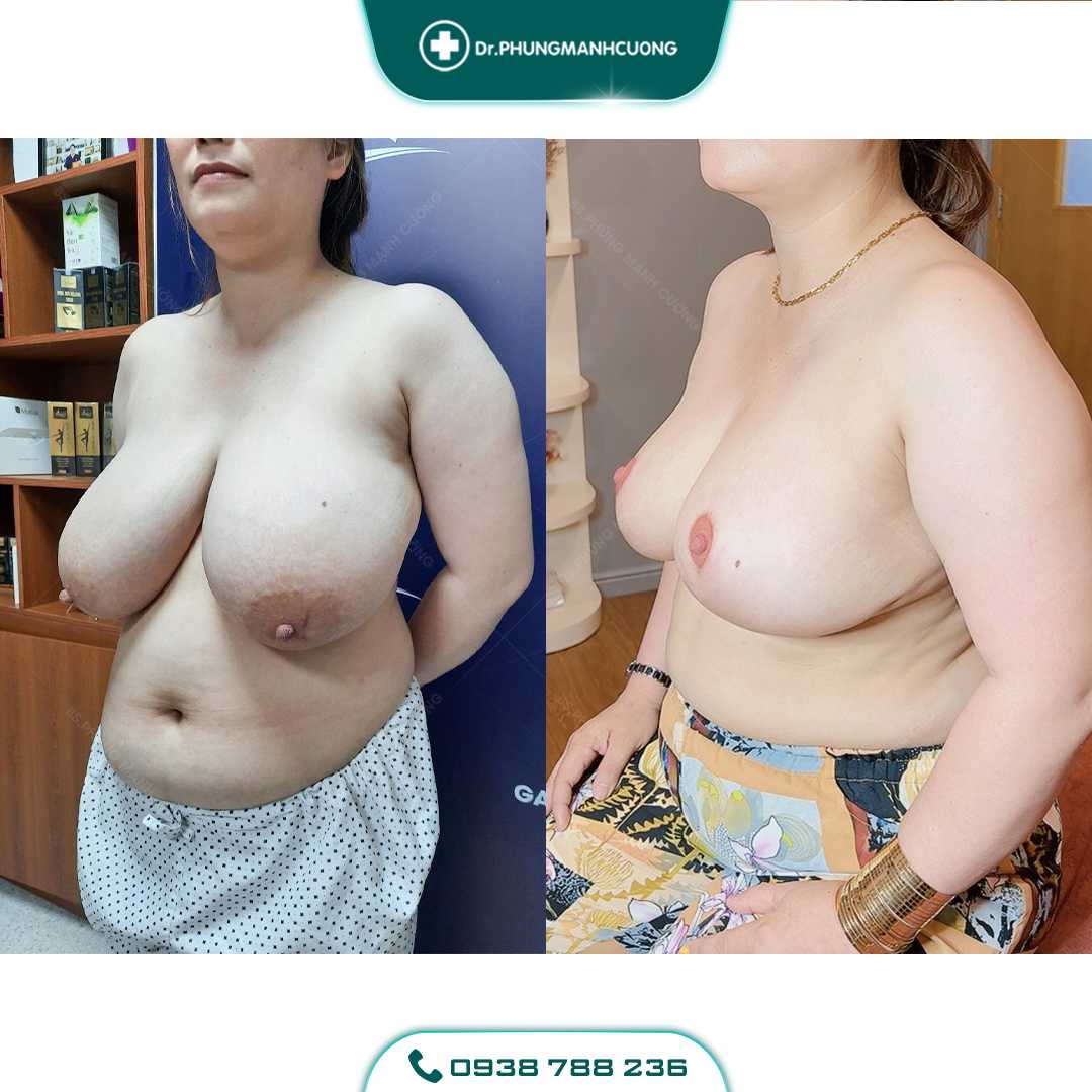 Thu Nhỏ Vú Phì Đại Giải Pháp Khắc Phục Bầu Ngực Sập Xệ 17 4 PMC