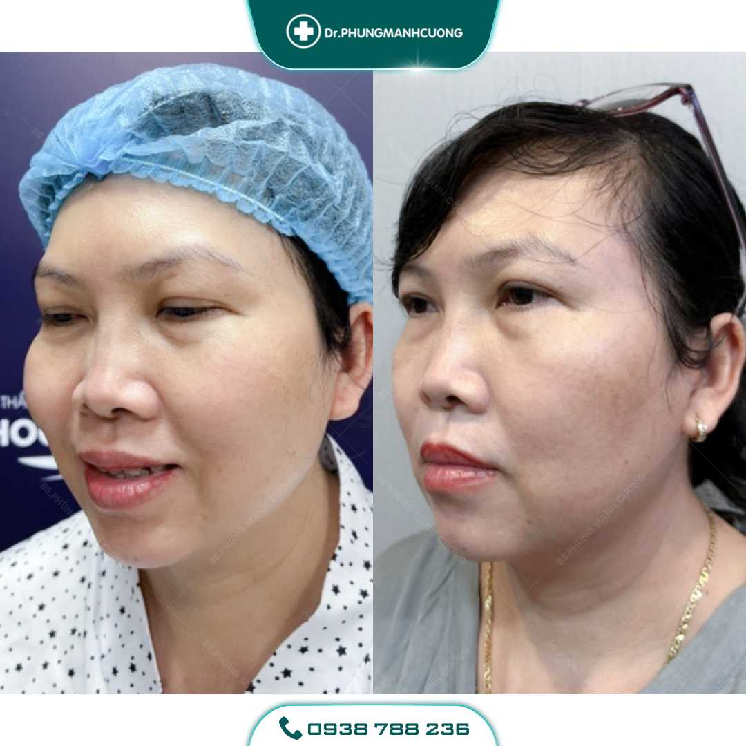 Hút Mỡ Mặt, Hút Mỡ Má Cho Khuôn Mặt Thon Gọn V Line 20 4 PMC