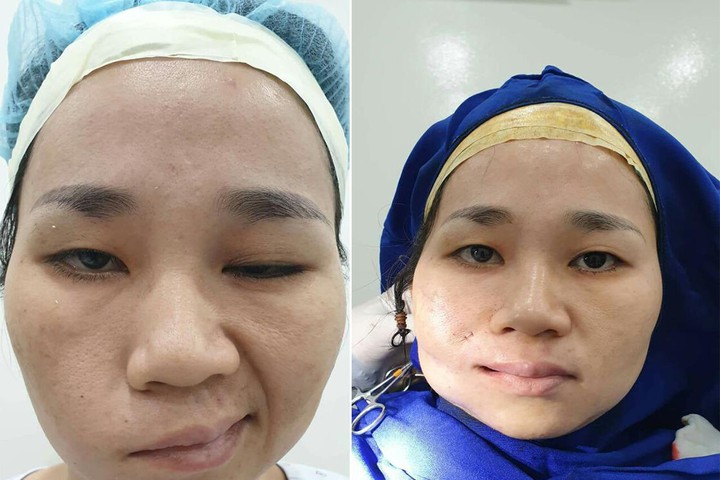 Điều Trị Liệt Mặt Ngoại Biên An Toàn, Hiệu Quả 100% 23 Bác Sĩ Chỉnh Liệt Dây Thần Kinh Số 7 (Liệt Cơ Mặt) Tốt Nhất Ở TPHCM