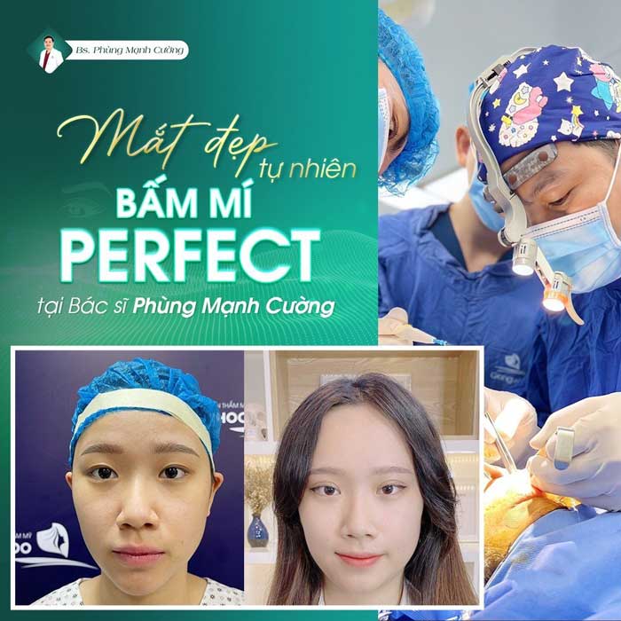 Bấm mí Perfect tại BS Phùng Mạnh Cường cho đôi mắt đẹp tự nhiên