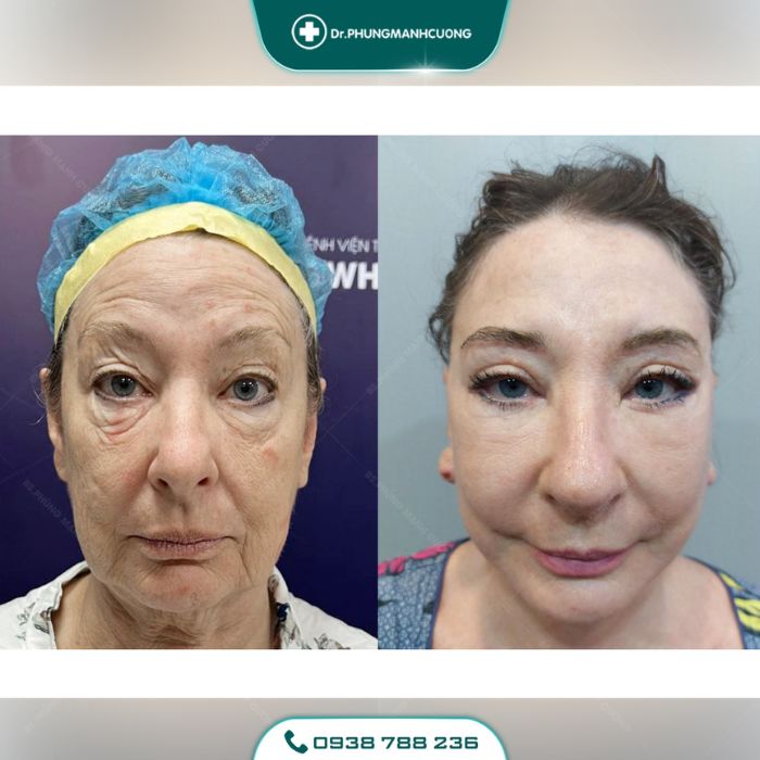 cac loai chi cang da mat 10