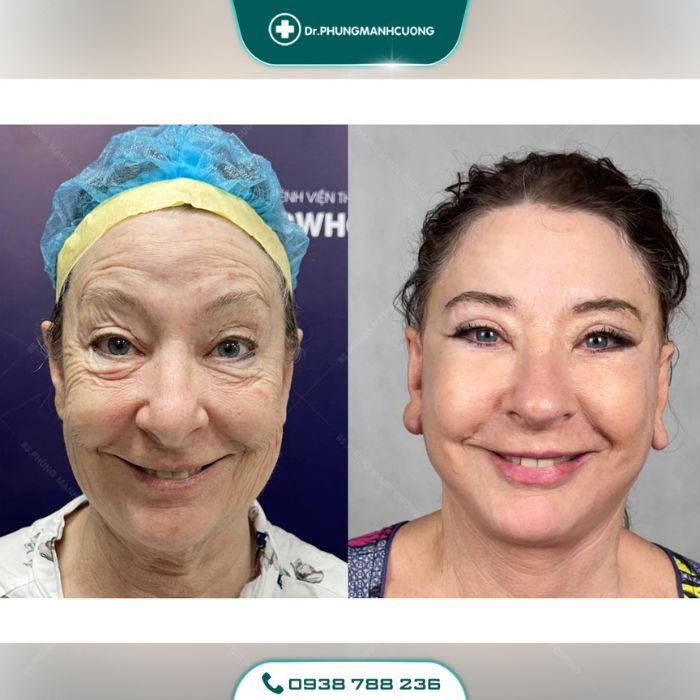 cac loai chi cang da mat 9