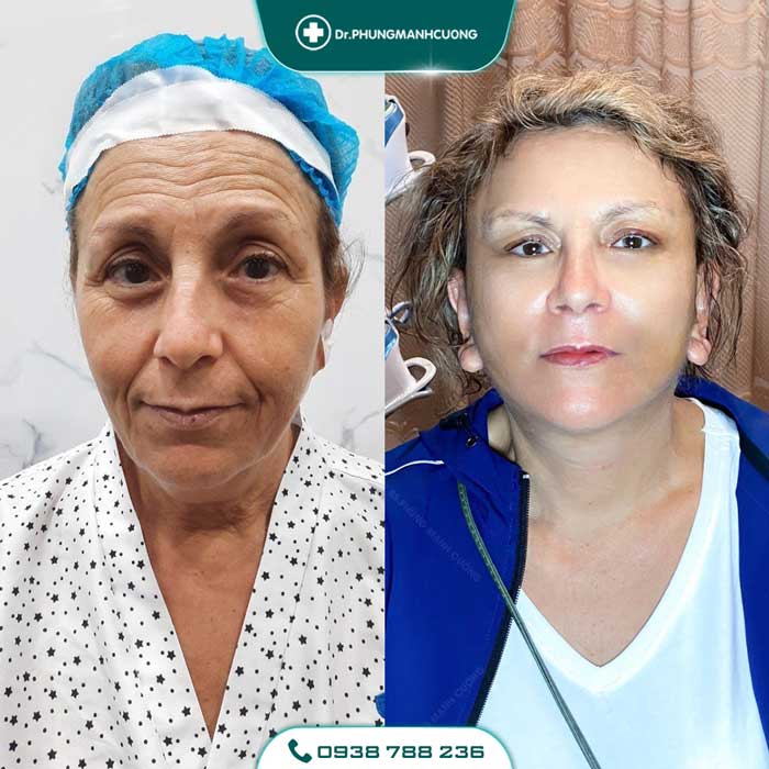 Cắt Da Thừa Vùng Mặt - "Hồi Xuân" Cho Da Chỉ Sau 30P 27 cang da mat 1 1