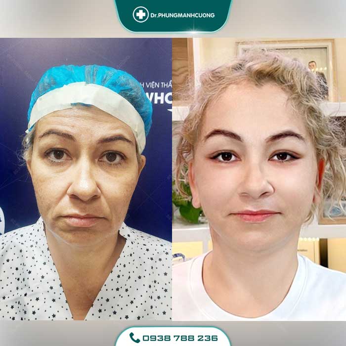 Cắt Da Thừa Vùng Mặt - "Hồi Xuân" Cho Da Chỉ Sau 30P 26 cang da mat 11 1
