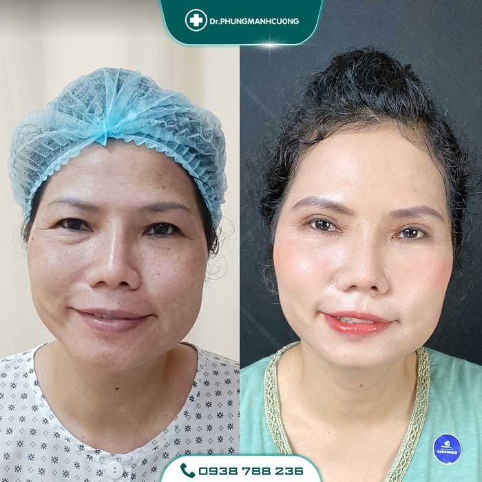 Căng Da Mặt Trẻ Hóa Bằng Chỉ Firin Nano Collagen Lấy Lại Thanh Xuân, Xóa Mờ Nếp Nhăn 27 cang da mat 14 1