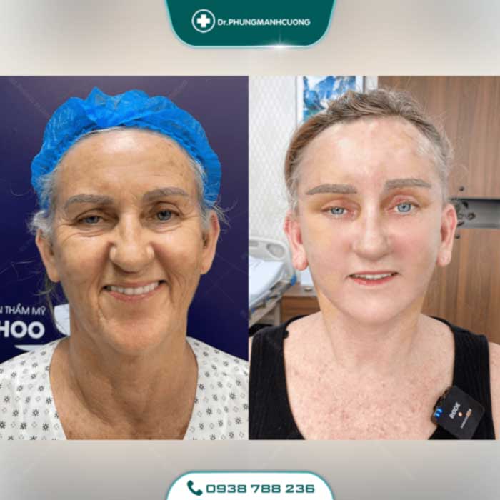 Cắt Da Thừa Vùng Mặt - "Hồi Xuân" Cho Da Chỉ Sau 30P 22 cang da mat 15 1