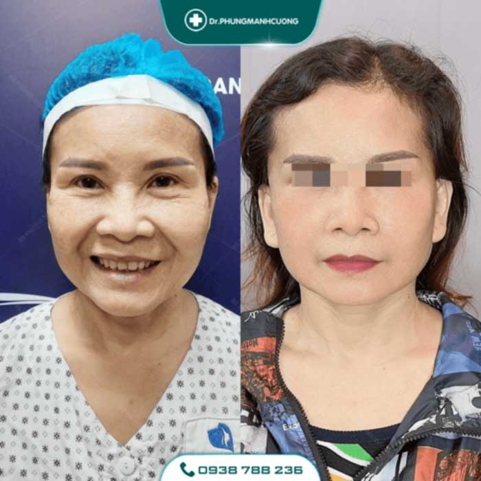 Cắt Da Thừa Vùng Mặt - "Hồi Xuân" Cho Da Chỉ Sau 30P 23 cang da mat 17 1