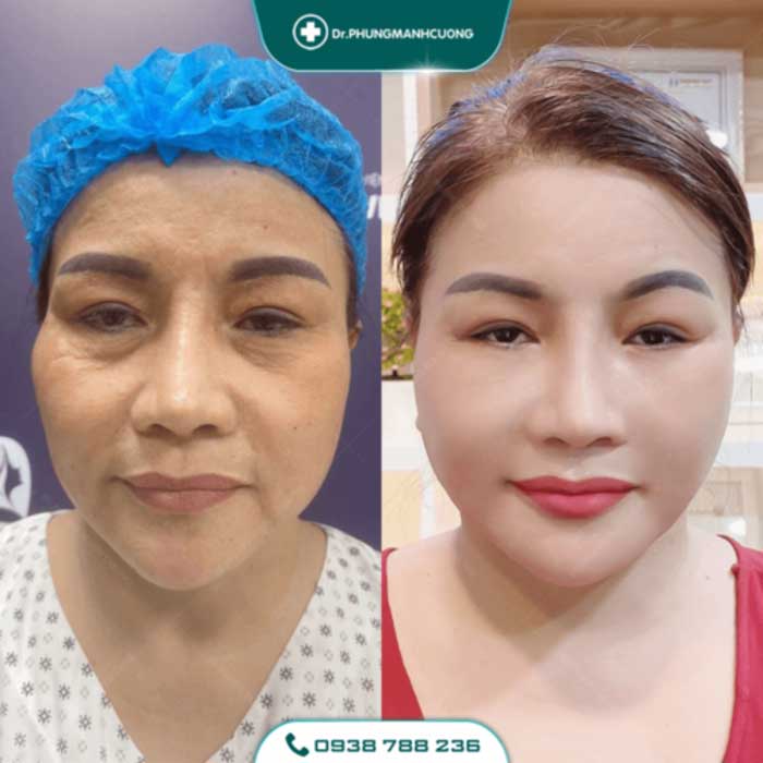 Căng Da Mặt Trẻ Hóa Bằng Chỉ Firin Nano Collagen Lấy Lại Thanh Xuân, Xóa Mờ Nếp Nhăn 28 cang da mat 22 1