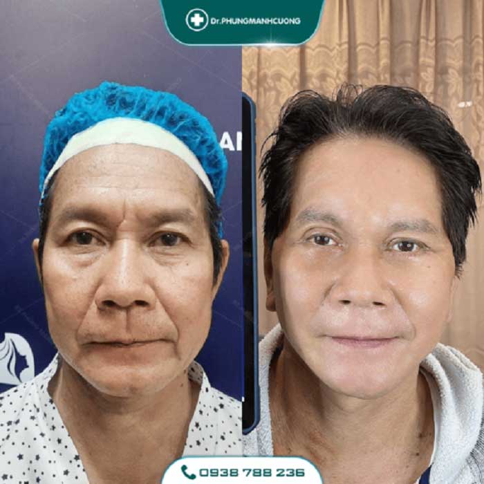 Căng Da Mặt Trẻ Hóa Bằng Chỉ Firin Nano Collagen Lấy Lại Thanh Xuân, Xóa Mờ Nếp Nhăn 24 cang da mat 23 1