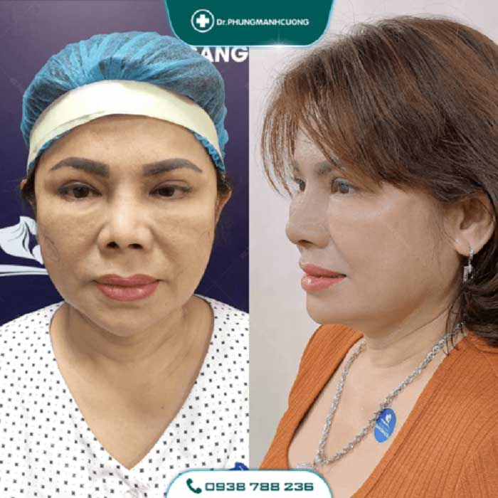 Cắt Da Thừa Vùng Mặt - "Hồi Xuân" Cho Da Chỉ Sau 30P 19 cang da mat 25 1