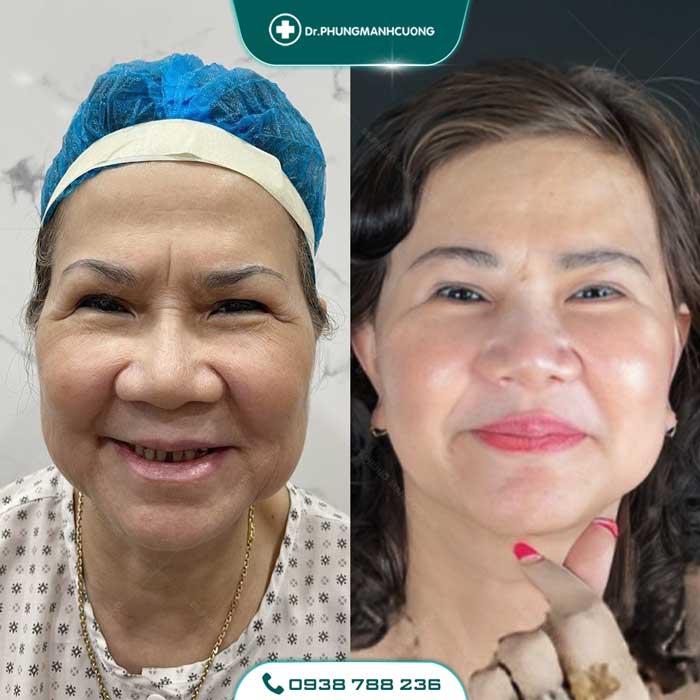 Căng Da Mặt Trẻ Hóa Bằng Chỉ Firin Nano Collagen Lấy Lại Thanh Xuân, Xóa Mờ Nếp Nhăn 26 cang da mat 28