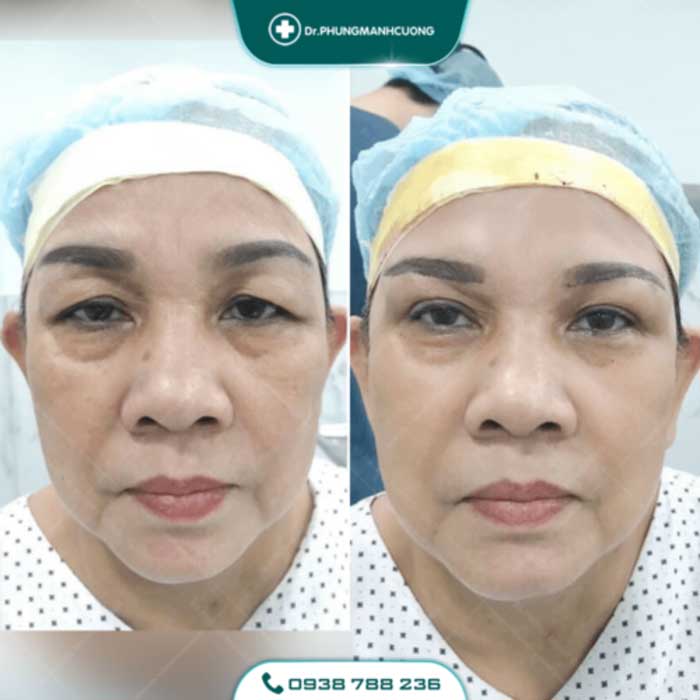 Cắt Da Thừa Vùng Mặt - "Hồi Xuân" Cho Da Chỉ Sau 30P 18 cang da mat 30 1