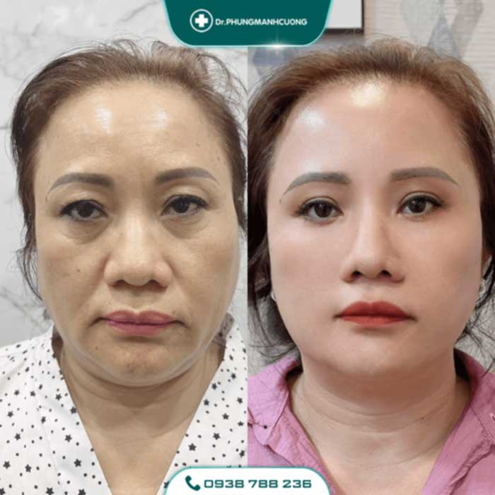 Cắt Da Thừa Vùng Mặt - "Hồi Xuân" Cho Da Chỉ Sau 30P 20 cang da mat 33 1