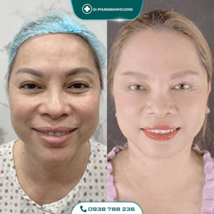 Căng Da Mặt Trẻ Hóa Bằng Chỉ Firin Nano Collagen Lấy Lại Thanh Xuân, Xóa Mờ Nếp Nhăn 25 cang da mat 4 1