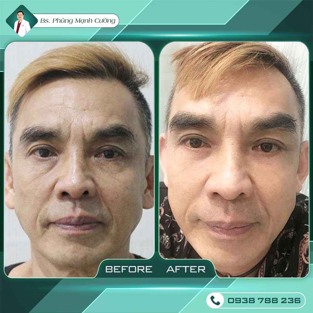 Căng da mặt bằng chỉ - Nhẹ Nhàng ít xăm lấn