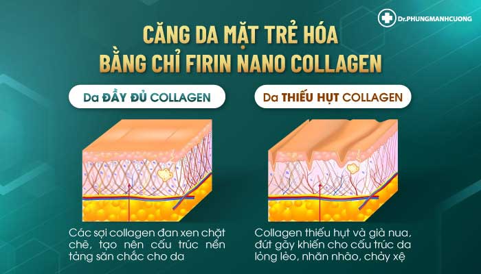 Căng Da Mặt Trẻ Hóa Bằng Chỉ Firin Nano Collagen Lấy Lại Thanh Xuân, Xóa Mờ Nếp Nhăn 21 Căng da mặt bằng chỉ Firrin Nano Collagen giúp tăng sinh collagen