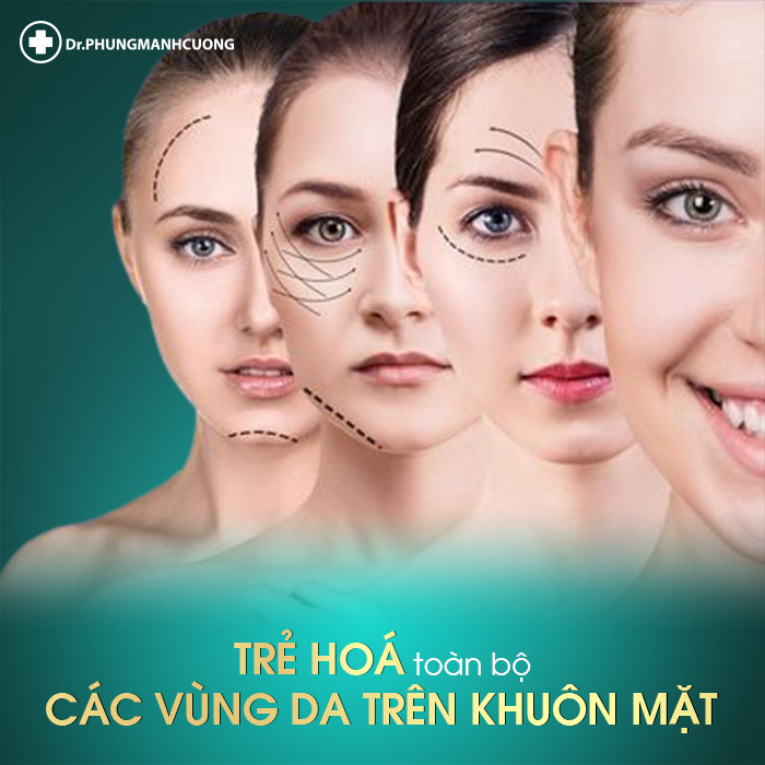 Căng da mặt bằng chỉ nâng cơ Lifting Collagen giúp bạn trẻ hóa toàn bộ các vùng da trên khuôn mặt
