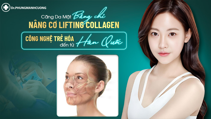 Căng da mặt bằng chỉ nâng cơ Lifting Collagen là sự kết hợp tuyệt vời giữa tần số vô tuyến từ thiết bị Thermage và công nghệ căng chỉ nâng cơ.