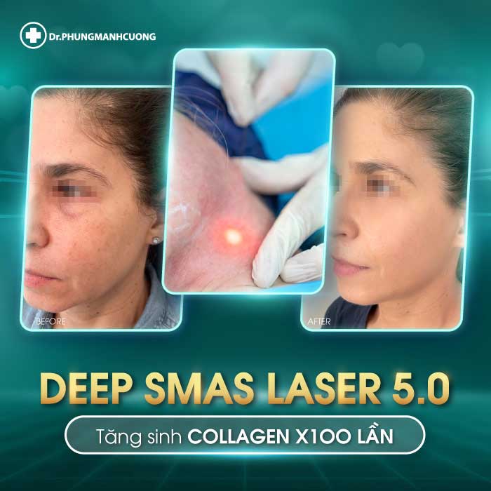 cang da mat deep smas laser 2 1
