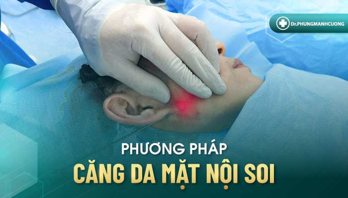 Phương pháp căng da mặt nội soi