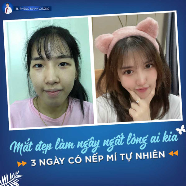 Cắt Mí (Hàn Quốc) Xong Là Hóa Hot Girl