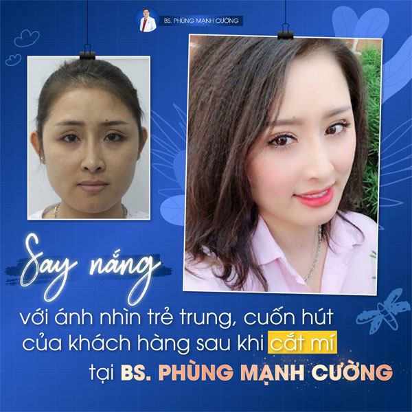 Cắt Mí Dưới (Perfect) - Giải Pháp Tất Yếu Cho Đôi Mắt Lão Hóa 14 Cắt Mí Dưới (Perfect) lấy lại vẻ tươi trẻ