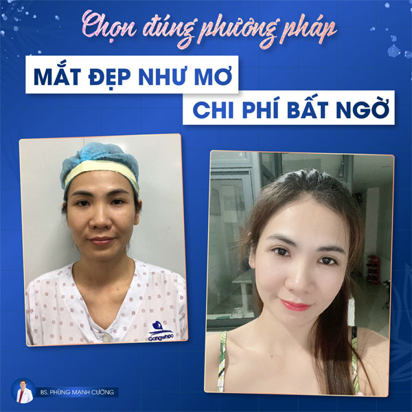 Cắt Mí (Hàn Quốc) Xong Là Nâng Tầm Nhan Sắc