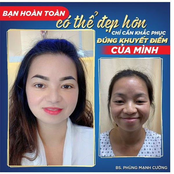 Cắt Mí 4 in Plasma đánh bay mắt nhỏ, mắt hí, mắt 1 mí