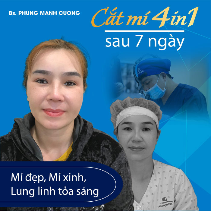 Cắt Mí 4 Trong 1 Plasma